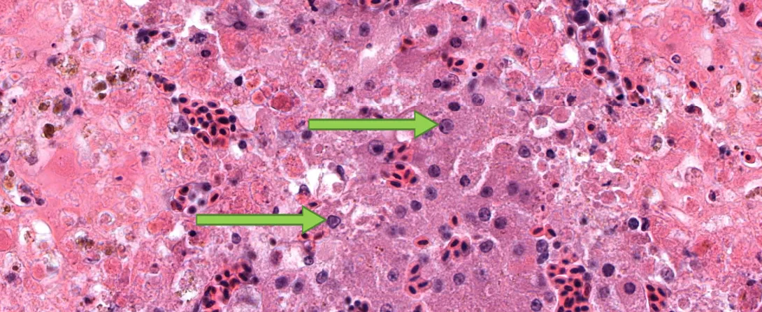 Rabies One of the most frequent questions the public or the biologists have when they find a mammal acting abnormally or dead is  “does it have rabies?” We send all of our samples to the NY State Department of Health (DOH) for official rabies testing, but we sometimes will look at histology of the brain of suspected rabid animals under the microscope, particularly if  the sample that we sent to the DOH was not ideal. In the case pictured, the rabies test at DOH was positive. Numerous rabies virus inclusion 