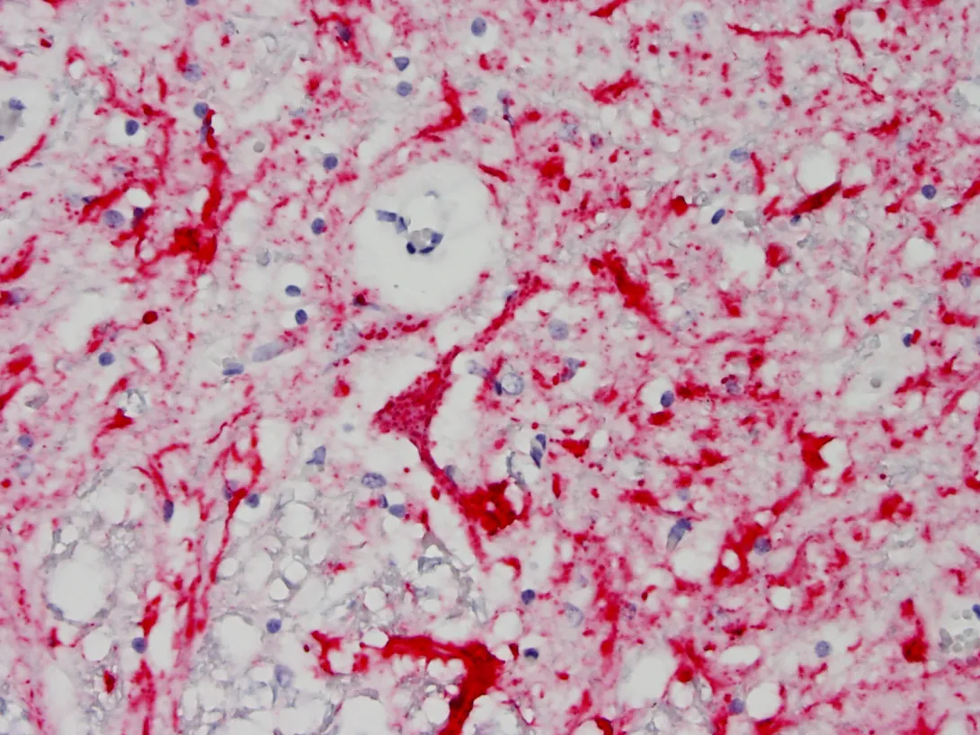 Histo slide of positive neuron test result