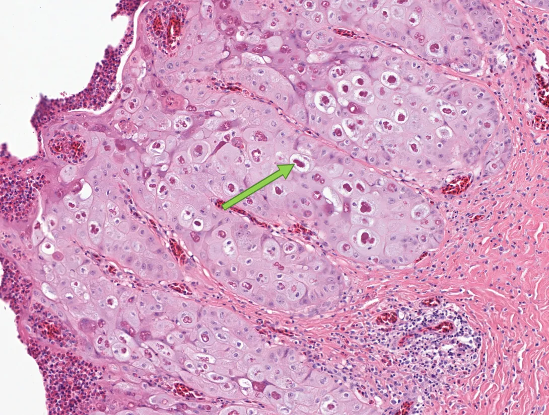 Poxvirus lesions in a wild turkey histo image
